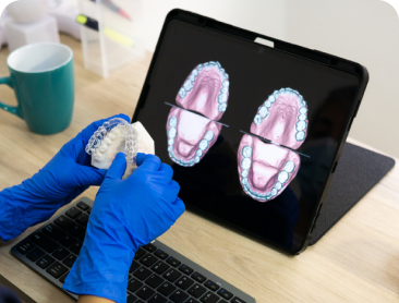 Gloved clinician holding a clear aligner beside a digital dental scan on a laptop